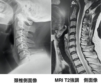 頚椎側面像、MRI T2 強調側面像
