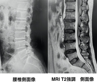 腰椎側面像、MRI T2 強調側面像