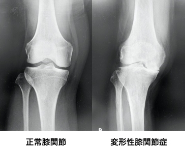正常膝関節、変形性膝関節症